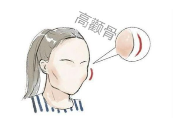 高颧骨案例展示