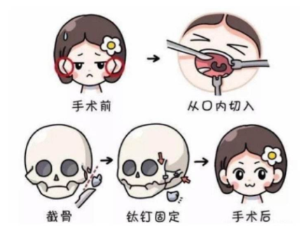 颧骨内推手术过程展示案例