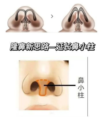 鼻小柱延长案例展示详情