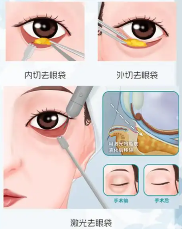 祛眼袋类型展示分析