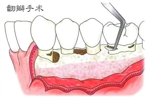翻瓣充填