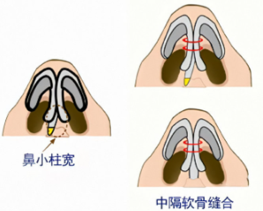 鼻小柱延长示意图