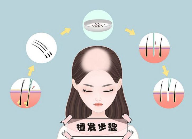 植发