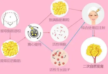 自体脂肪填充技术原理示意