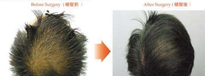 广州植发价格：植发前后对比图