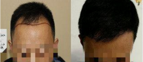 头发种植后的效果 头发种植的价格 长长发网
