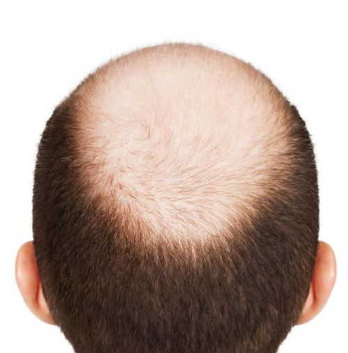 暂时性脱发与长久性脱发的区别在哪