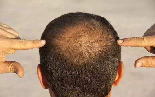 神经性脱发原因以及治疗方法有哪些