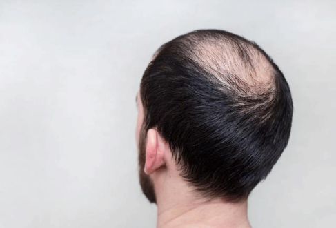 植发手术一般是取哪里的毛囊