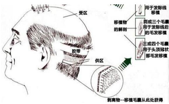 扬州市毛发移植手术的过程复杂吗