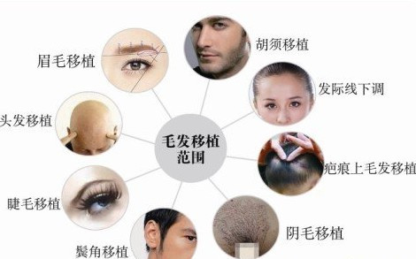 扬州市毛发移植手术的过程复杂吗