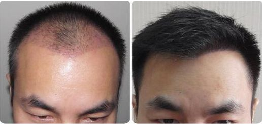 毛发移植手术治疗脱发问题是否可靠呢