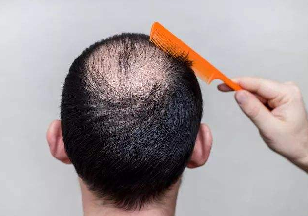 男性脱发要如何治疗呢