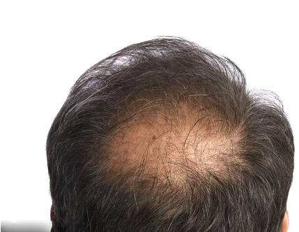 做秃顶植发手术要花多少钱，会很贵吗