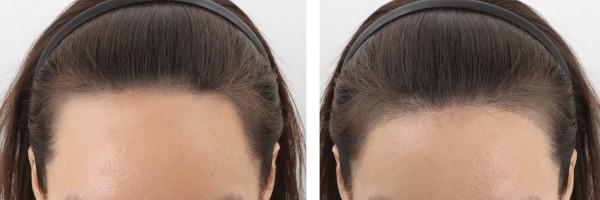 女性怎么增加头发改变发际线