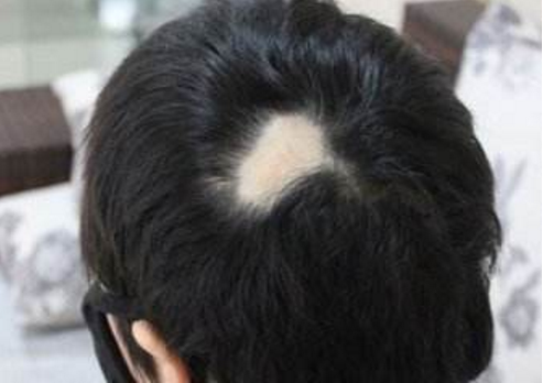 头上有疤痕可以做植发吗，疤痕植发的效果怎么样
