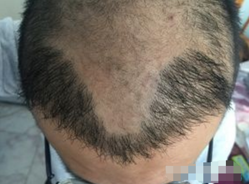 植发能够根治脂溢性脱发吗，植后还会掉吗