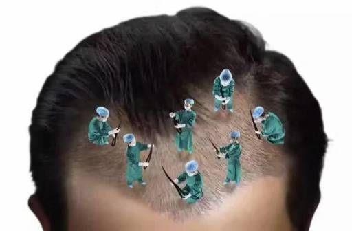头发种植手术的生长过程解析