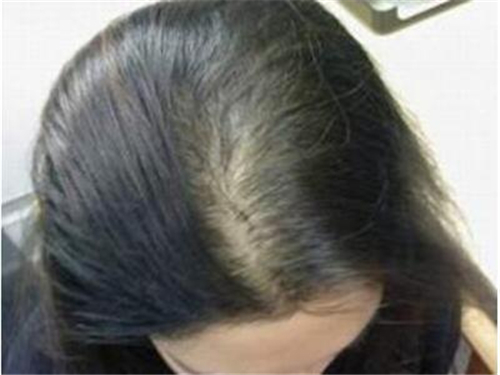 女性脂溢性脱发怎么治疗