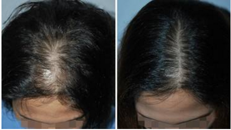 植发密度对手术效果有什么影响吗