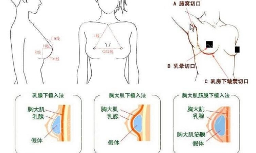 合肥前三胸部整形医生排名 任敏 朱飞 李小静实力技术哟