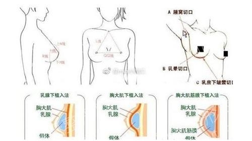 杭州隆胸医生排行榜top5