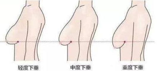 成都乳房下垂矫正